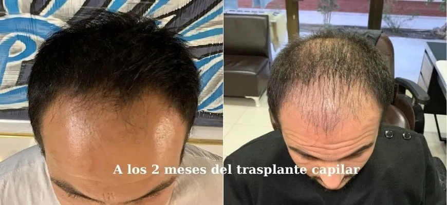 A los 2 meses del trasplante capilar