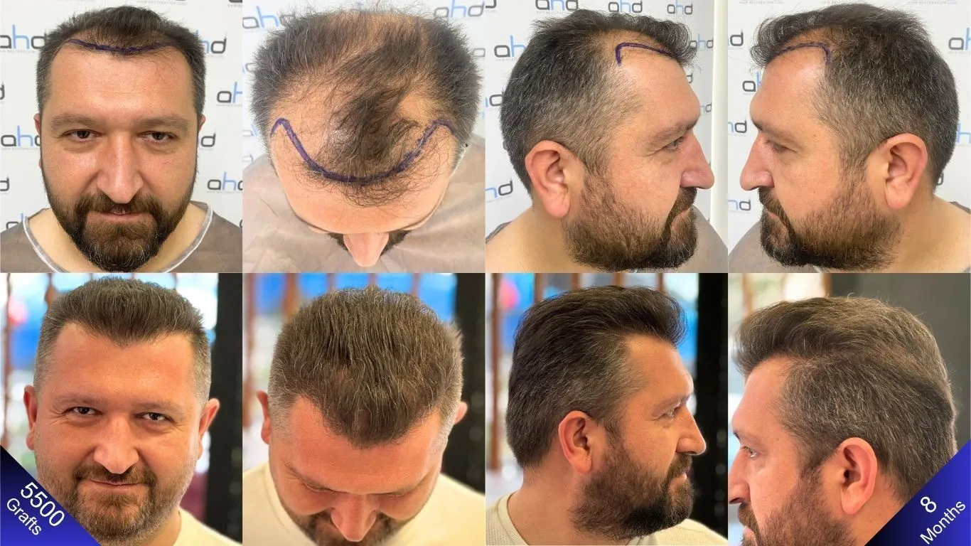 Sehen Sie das beste Haartransplantationsergebnis