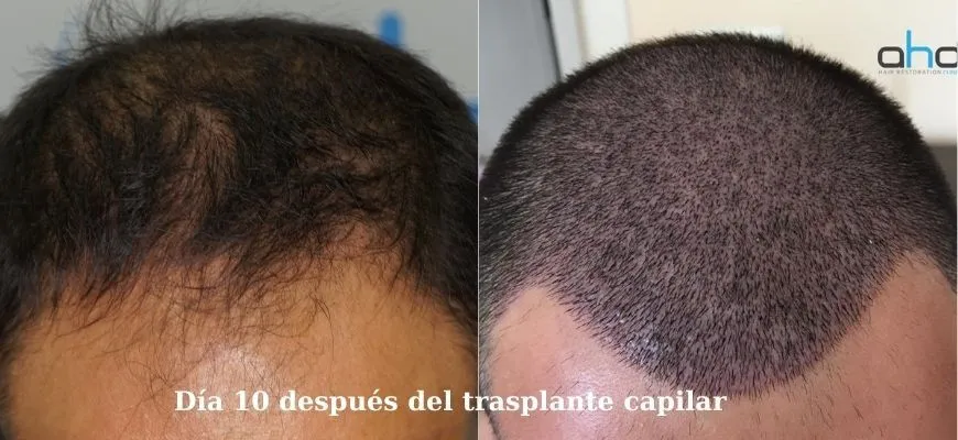 Imagen antes del trasplante de cabello y 10 días después.