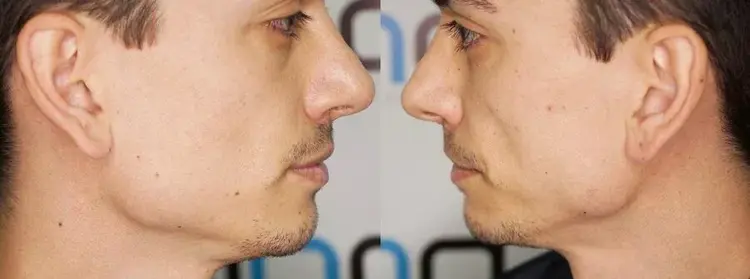 Een haartransplantatie kan worden uitgevoerd bij een man die helemaal geen baard heeft.