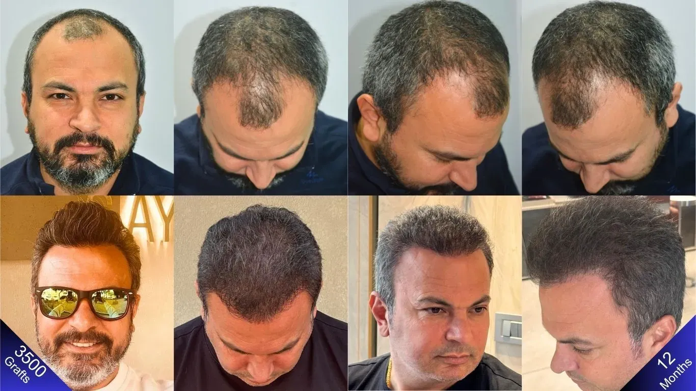 Het resultaat van een FUE-haartransplantatie met 3500 grafts