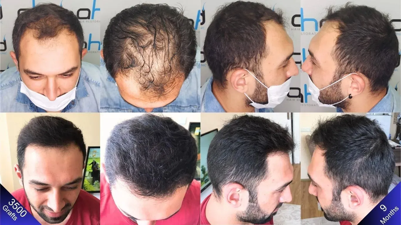 Onderzoek de verandering voor en 9 maanden na de haartransplantatie.