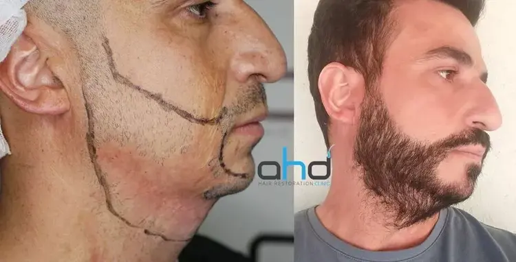 Na zijn baardtransplantatie is de man met het verbrande gezicht erg blij.