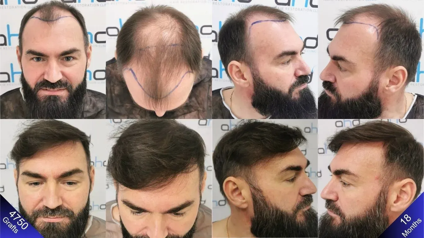 Hoe zag het eruit vóór de haartransplantatie? Wat voor resultaat heeft hij na 18 maanden bereikt? Het antwoord is hier.