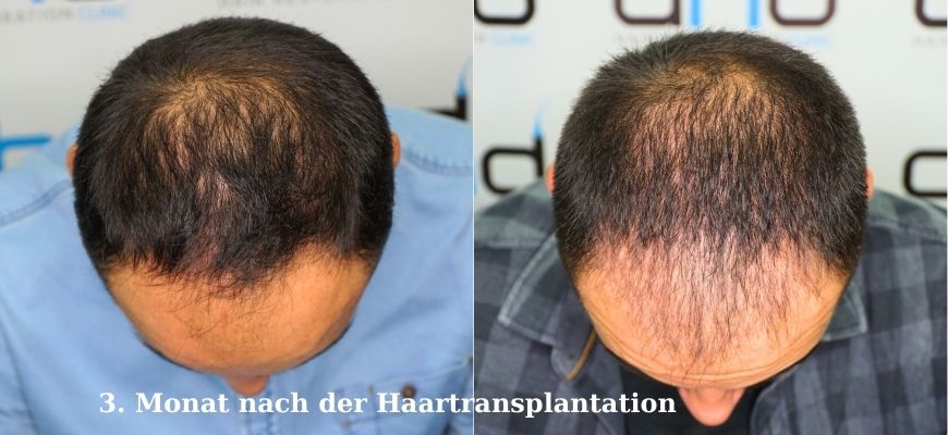 Der dritte Monat nach der Haartransplantation