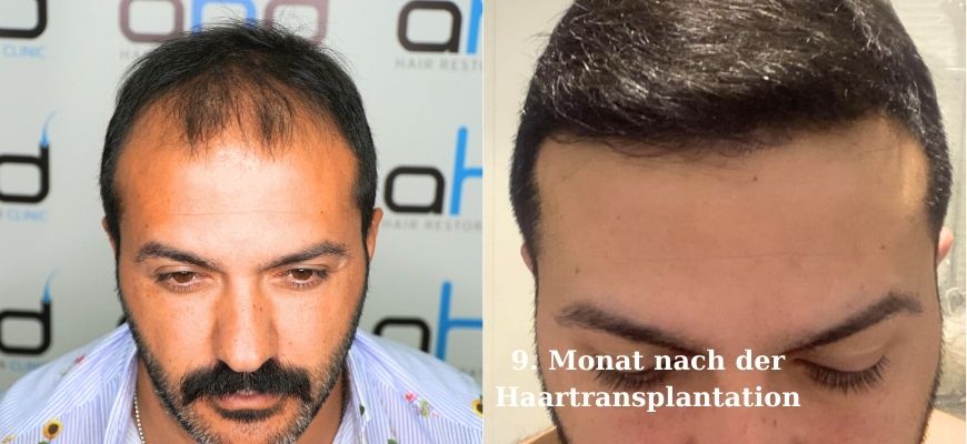 Haartransplantation – der 9. Monat