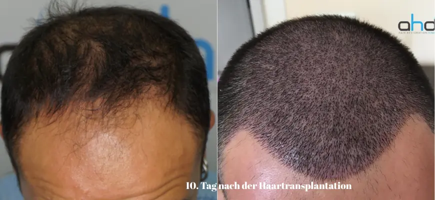 Haartransplantation: Das Ergebnis nach 10 Tagen