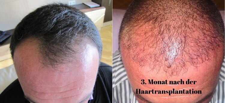 So sehen die Ergebnisse 3 Monate nach der Haartransplantation aus.