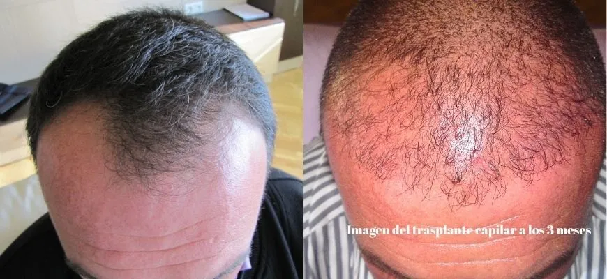 Trasplante de cabello en 3 meses