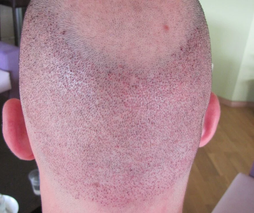 Área donante del primer día después del trasplante de cabello