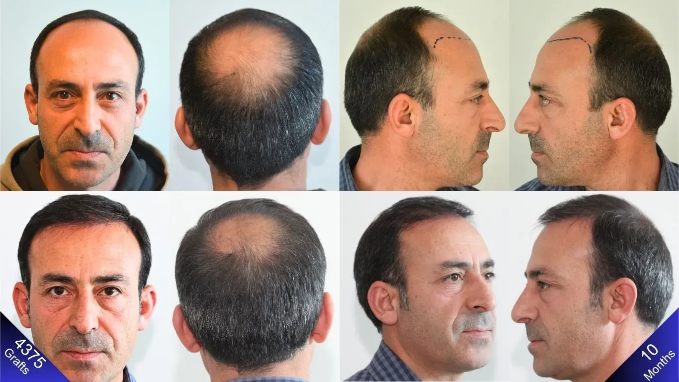 Fotos de antes y después de un hombre con alopecia Norwood 6 que se sometió a un trasplante de cabello de 4375 injertos.