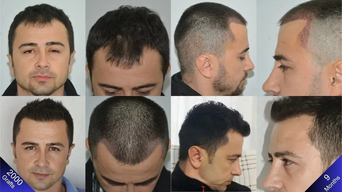 Een natuurlijke haarlijn bereikt met een haartransplantatie van 2000 grafts.