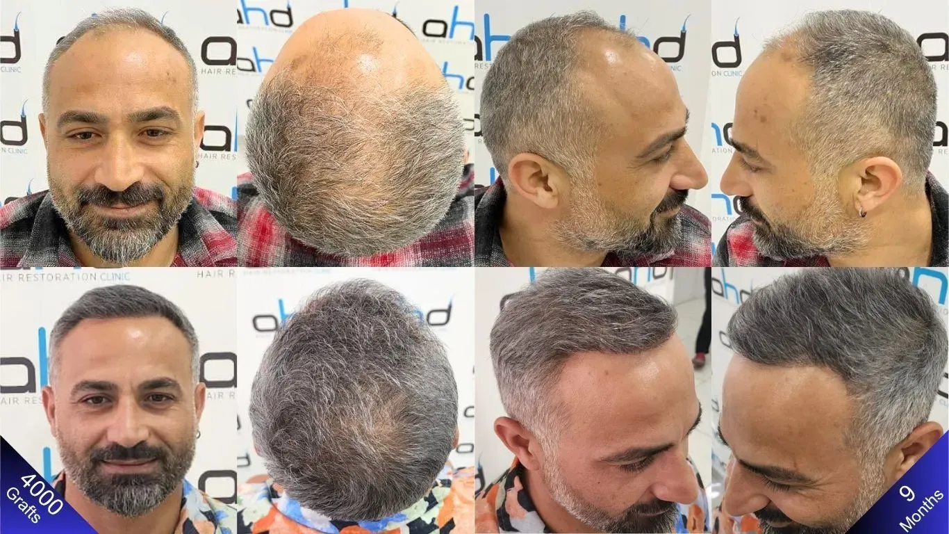 As fotos mostram antes e 9 meses depois de um transplante capilar realizado na Turquia.