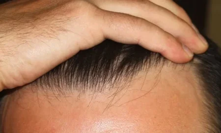 Resultados de trasplante de cabello