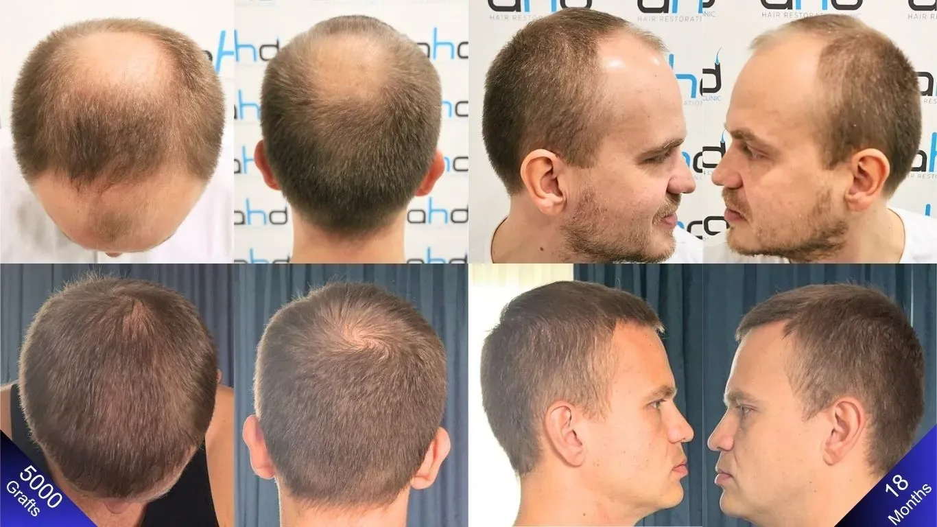 El resultado del trasplante de cabello del hombre que es feliz.