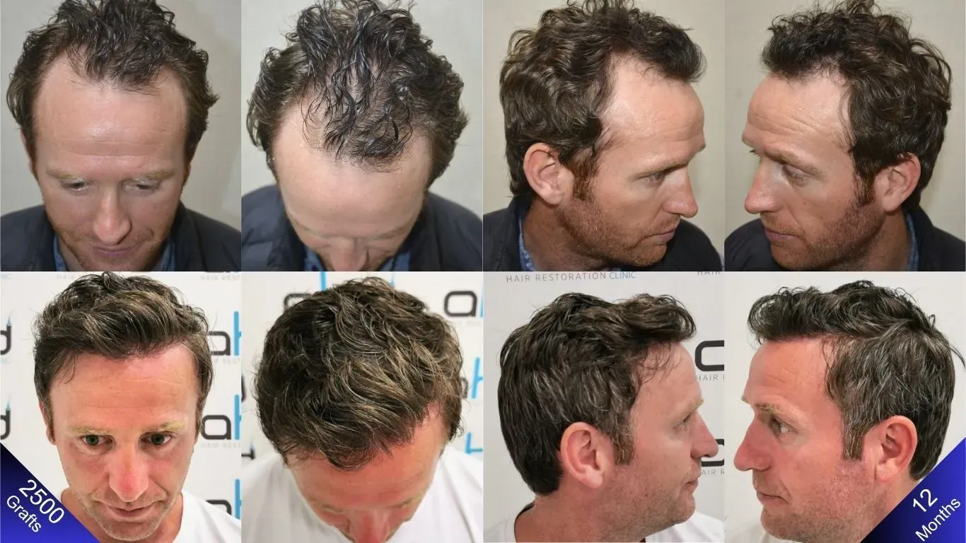 Los felices resultados del paciente que obtuvo una apariencia natural después del trasplante de cabello.