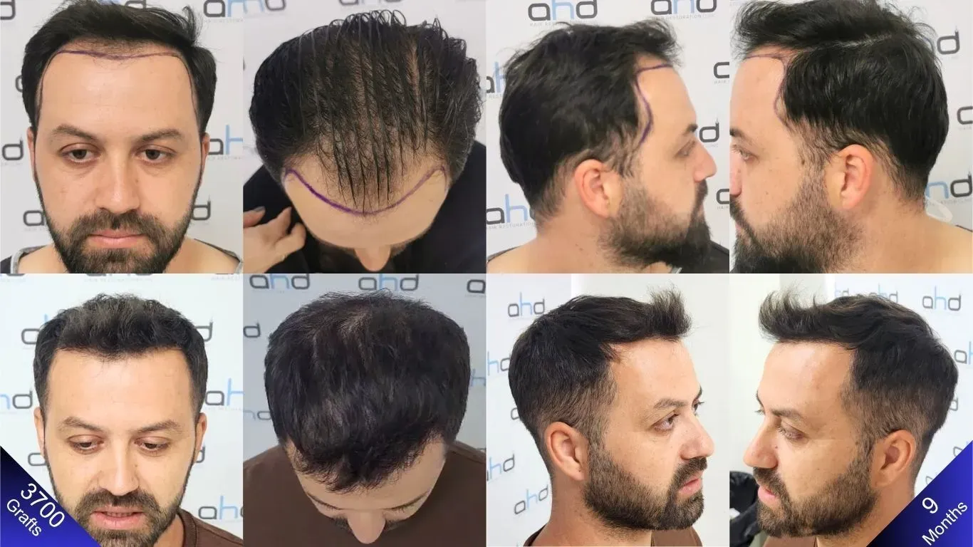 Foto's van voor en na die het resultaat tonen van een haartransplantatie met 3700 grafts, met zicht op de rechterzijde, linkerzijde, kruin en de voorkant.