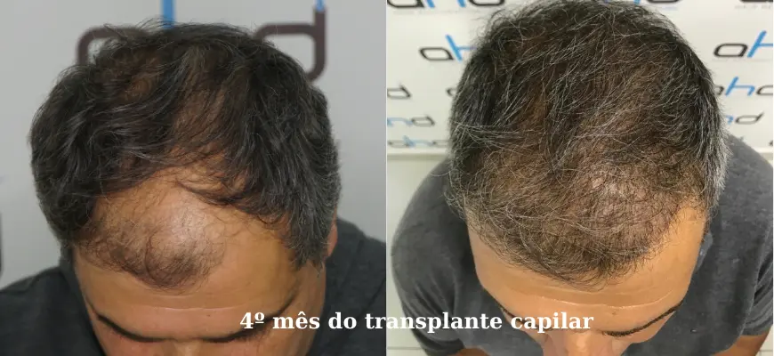 Como fica o transplante capilar no 4º mês?