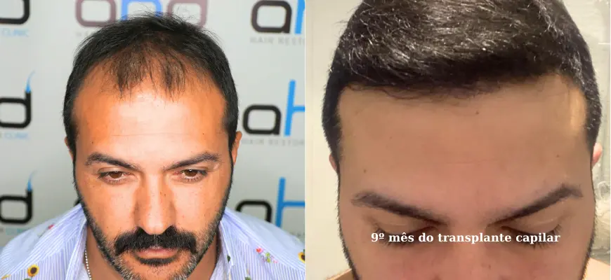Resultado incrível antes e 9 meses após o transplante capilar