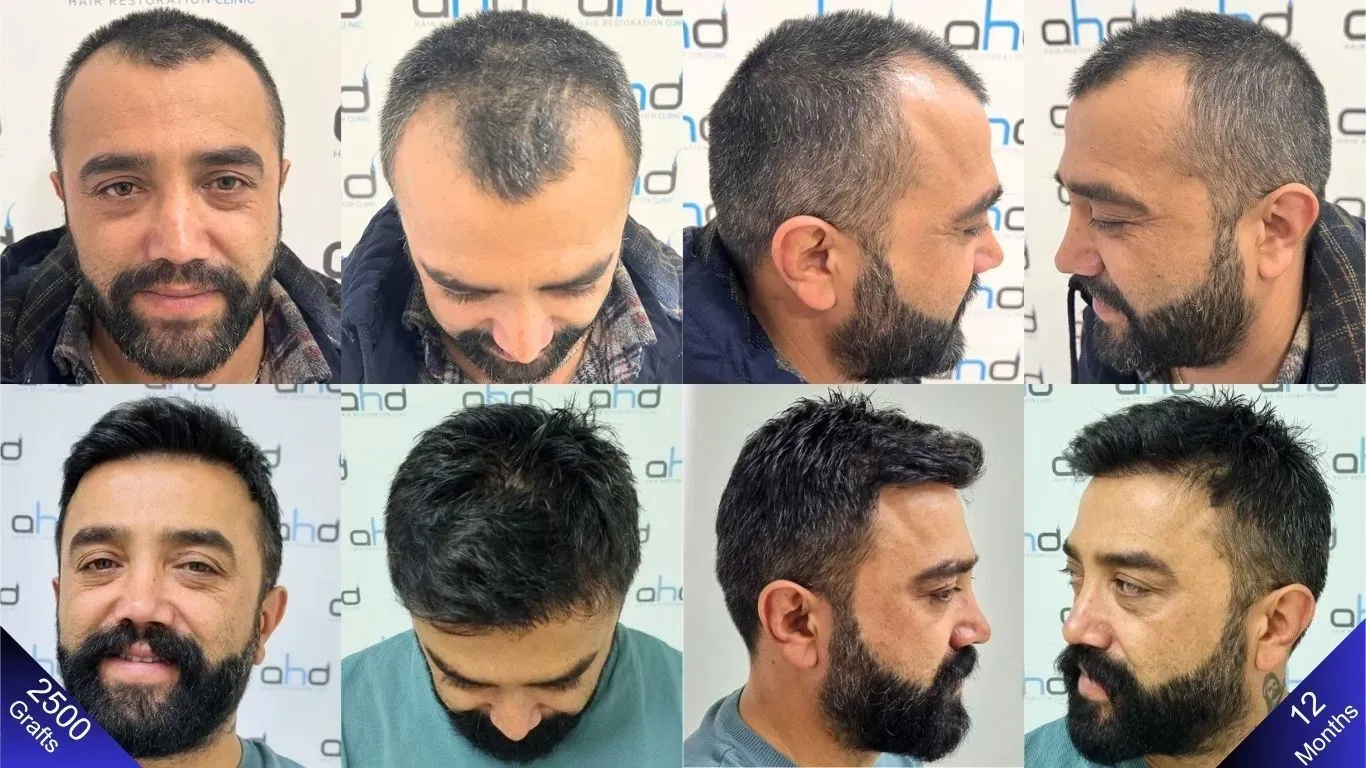 Os resultados do antes e depois do homem que se submeteu a um transplante capilar de 2500 enxertos.