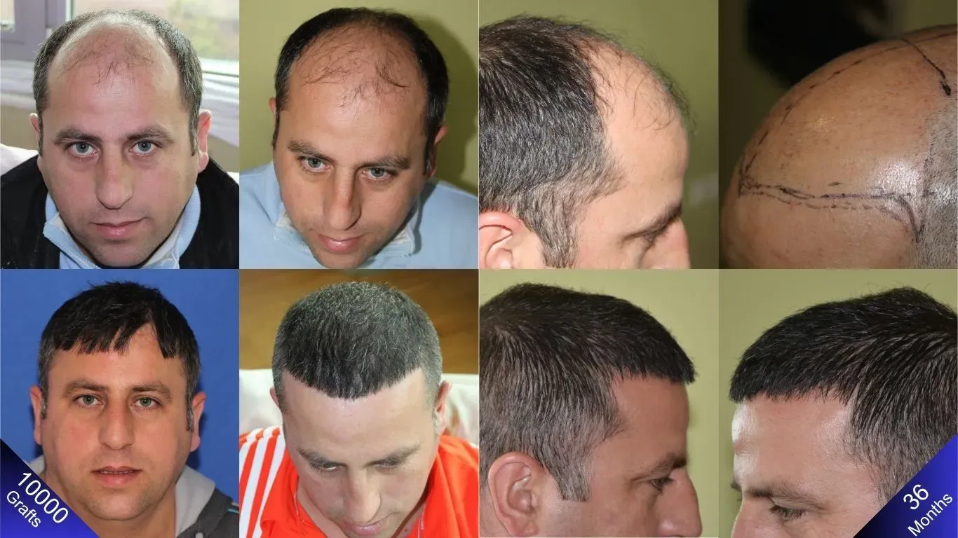 Il paziente Norwood 6 ha subito una trasformazione straordinaria con un trapianto di capelli di 10.000 innesti.