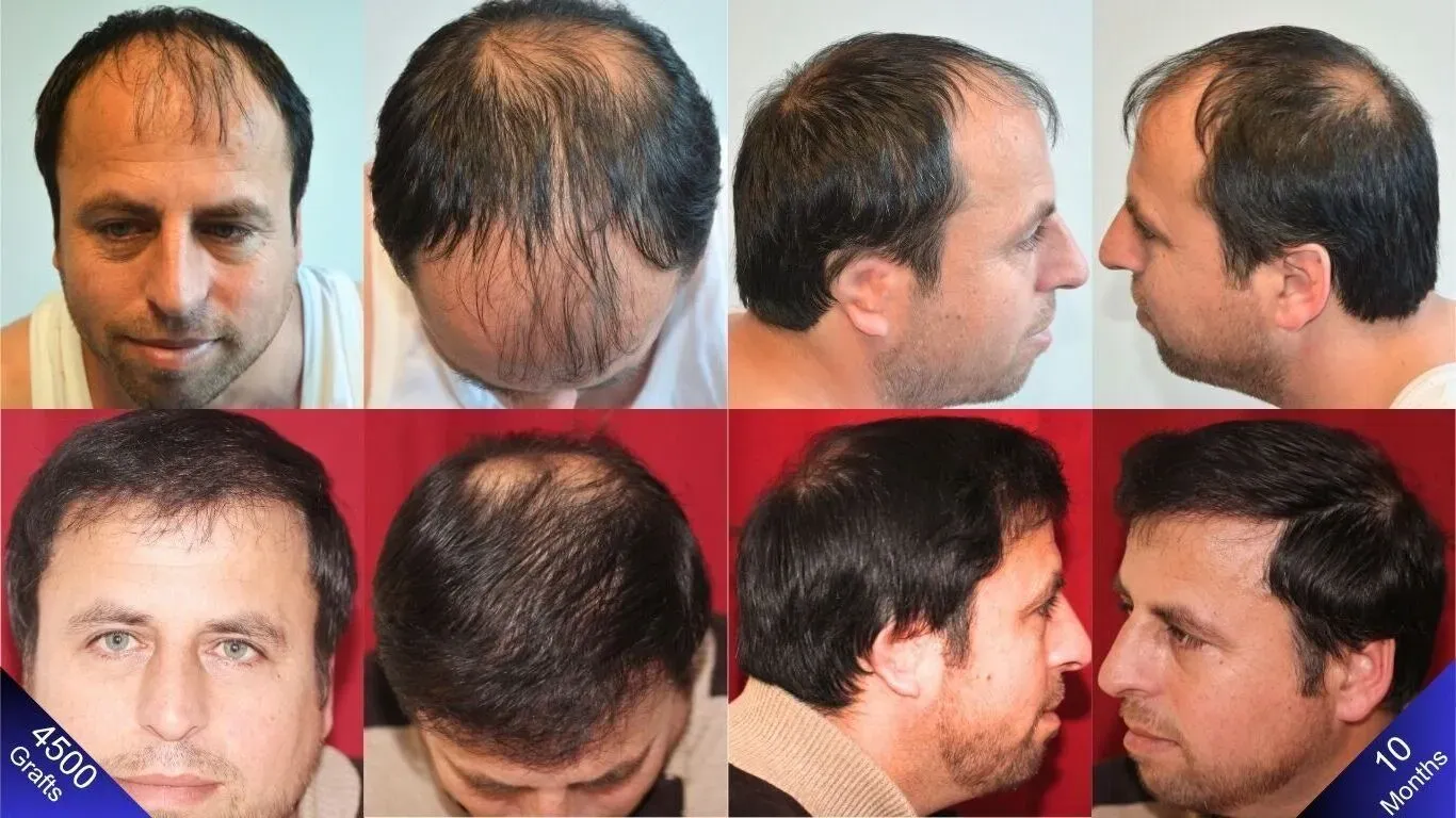 Il risultato naturale per l'uomo la cui gioia è evidente dal suo volto dopo il trapianto di capelli.