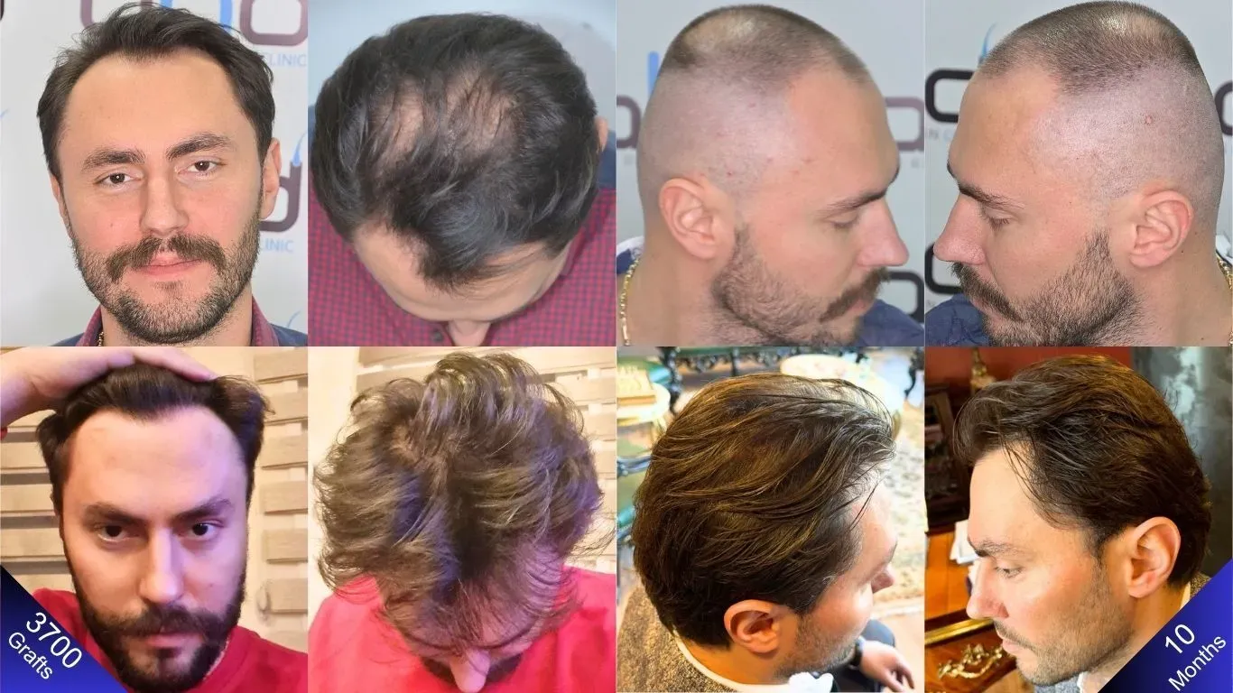 Een fantastische voor- en nafoto van de man, 10 maanden na een haartransplantatie van 3700 grafts.