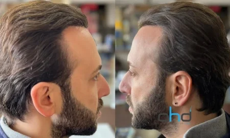 after hair ransplant