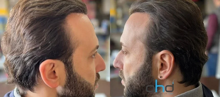 after hair ransplant