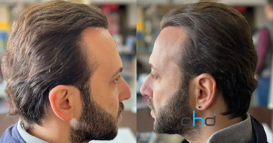 after hair transplant