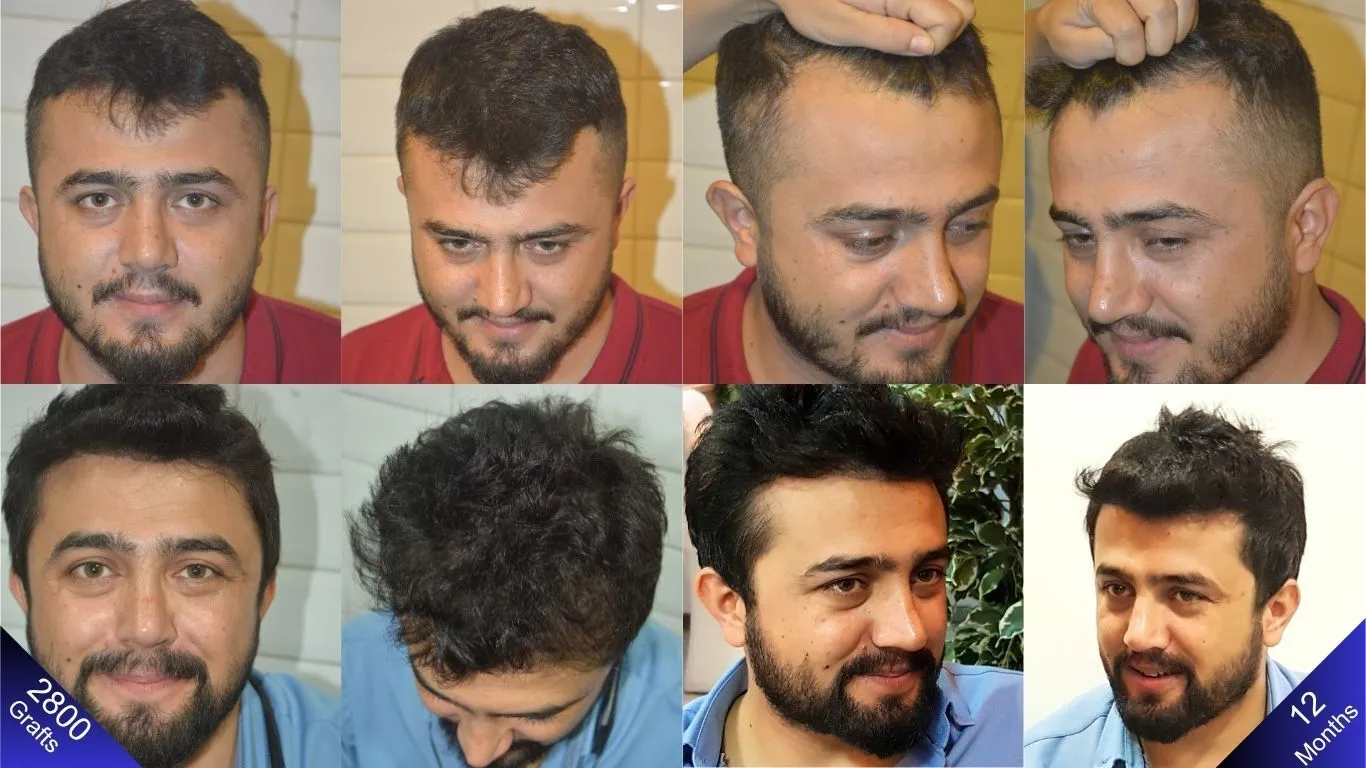 One year of change in the man who underwent simultaneous hair, beard, and mustache transplants.