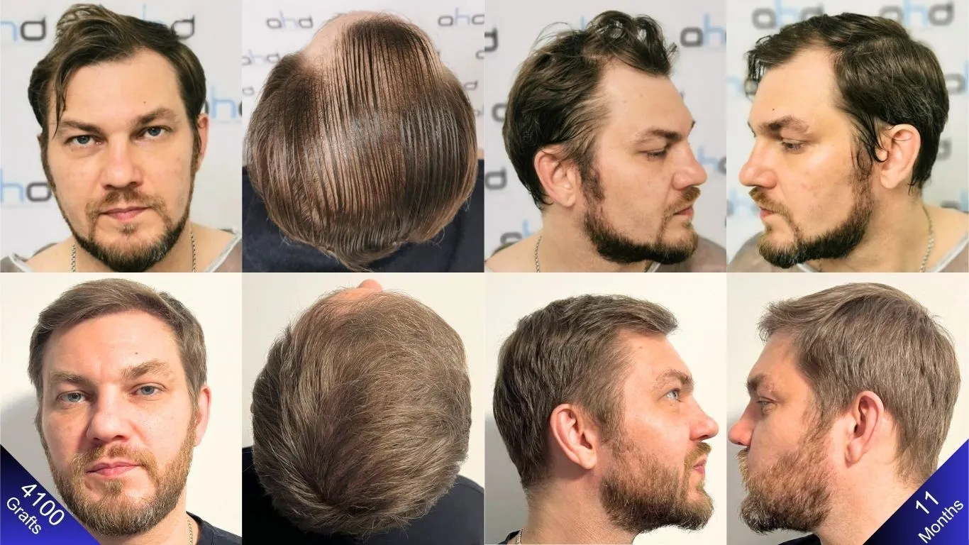 The change before and 11 months after a 4100-graft hair transplant.