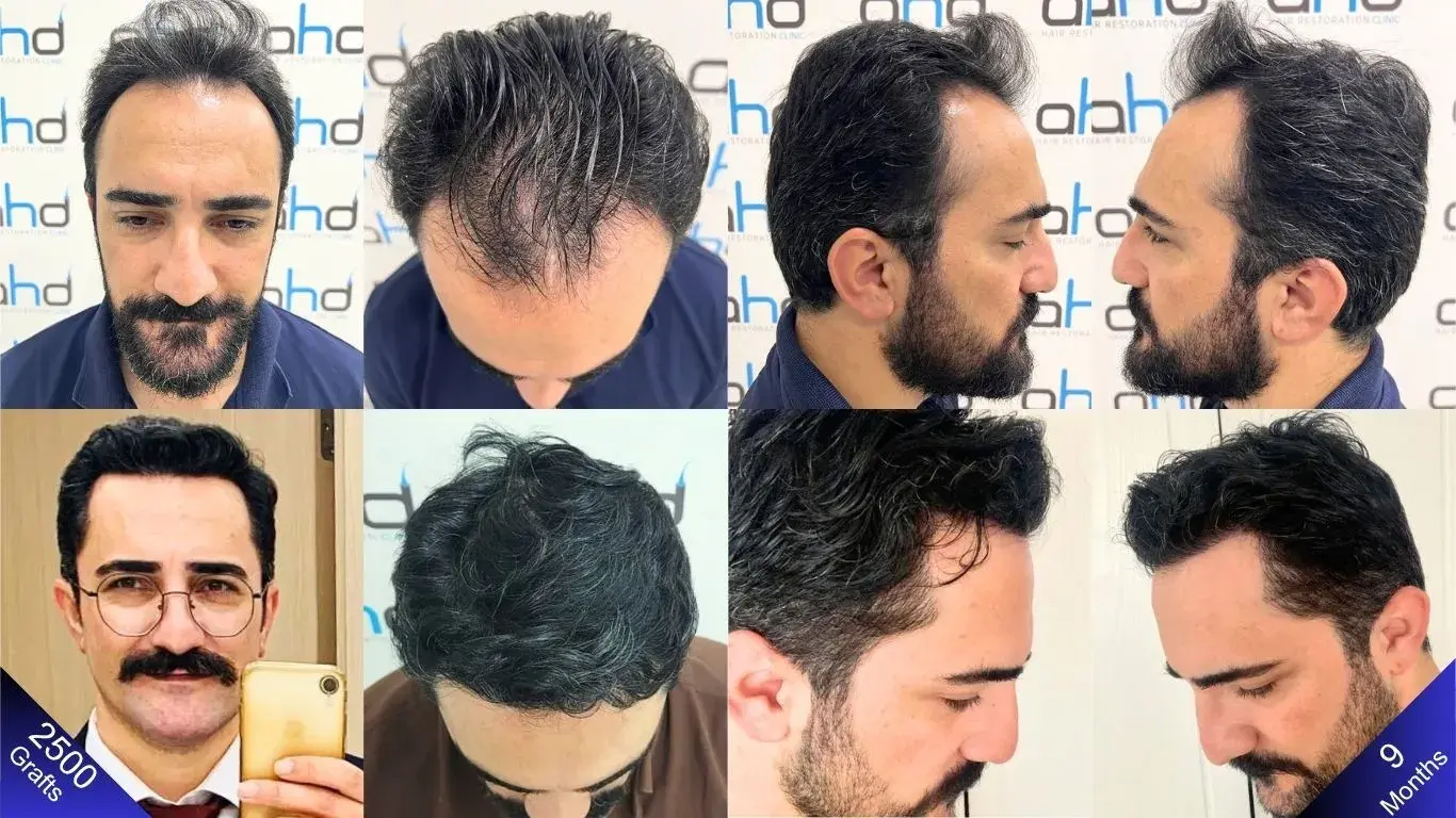 A joyful outcome nine months after the hair transplant.