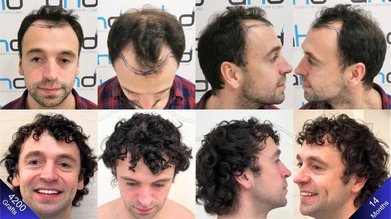 A man who had a 4200-graft hair transplant and achieved great results with a happy, smiling face after 14 months.
