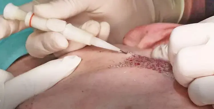 En optimale resultaten bij baardtransplantatie worden verkregen met de DHI-techniek.