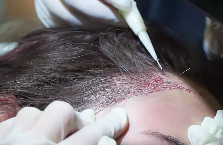 Op de foto is te zien hoe een haartransplantatie bij vrouwen met de DHI-methode wordt uitgevoerd.