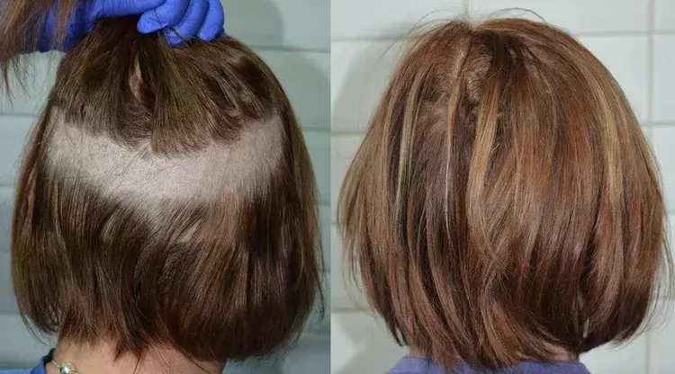 Voer haartransplantatie uit bij vrouwen volgens de scheerloze methode.