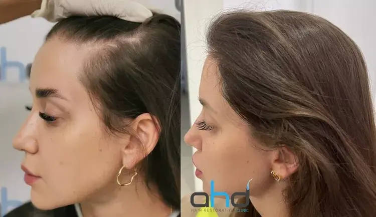 haartransplantatie voor en na vrouw