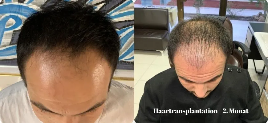 So sieht das Ergebnis einer Haartransplantation im 2. Monat aus