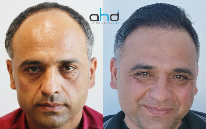 Die Ergebnisse vor und nach der Haartransplantation sollten natürlich aussehen