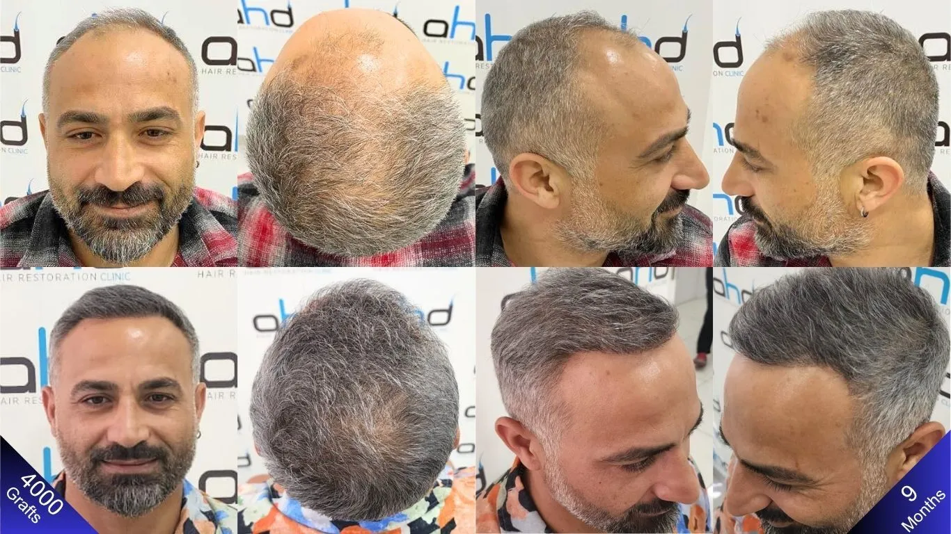 The photos show before and 9 months after a hair transplant performed in Turkey.