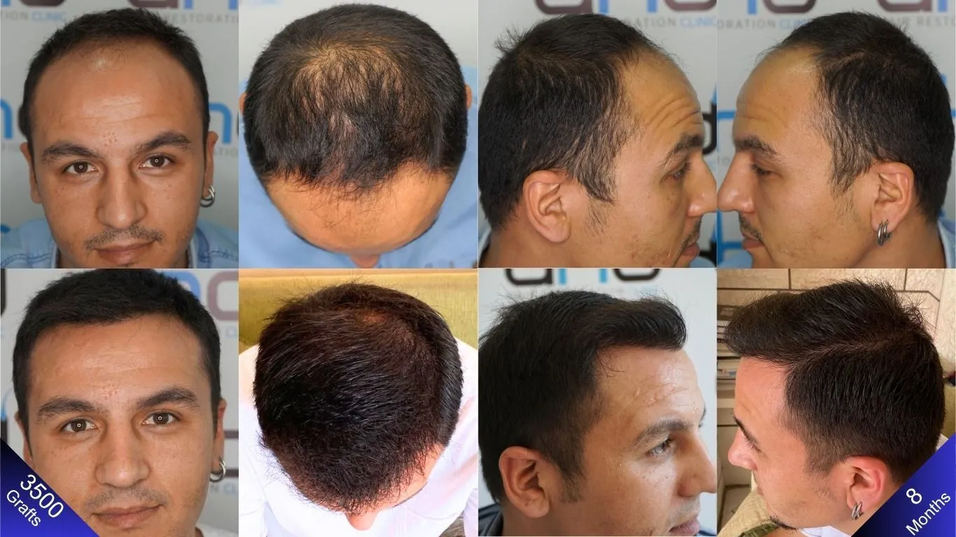 An amazing result achieved with a 3500-graft hair transplant.