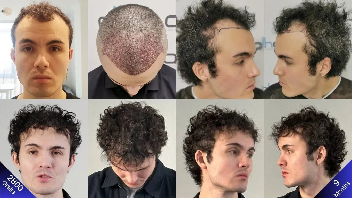 La apariencia natural del hombre antes y 9 meses después del trasplante de 2800 injertos.