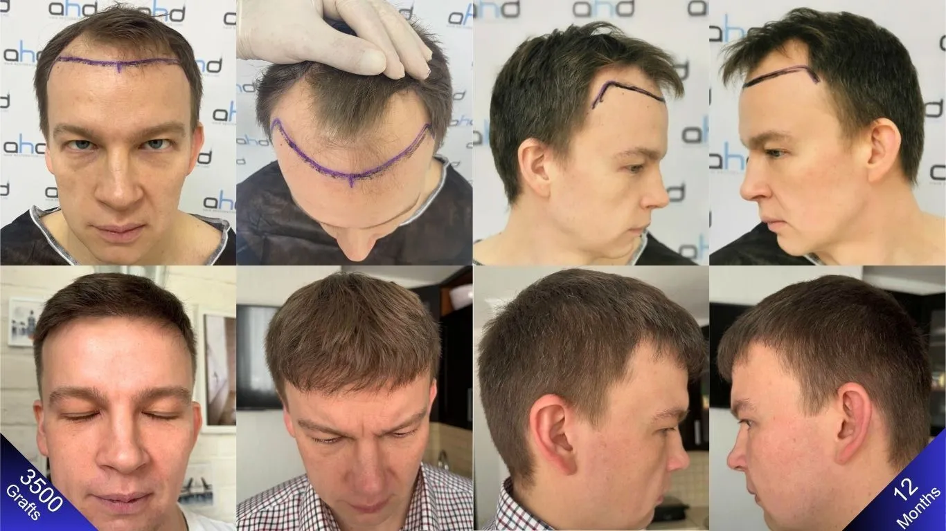 See the results comparing before the hair transplant and one year later, showing the difference in every aspect.