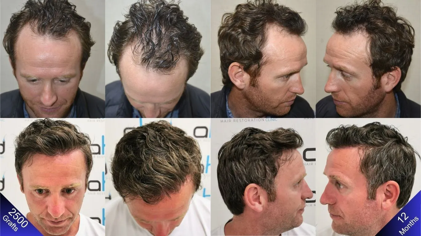 The happy outcomes of the patient who obtained a natural appearance after the hair transplant.