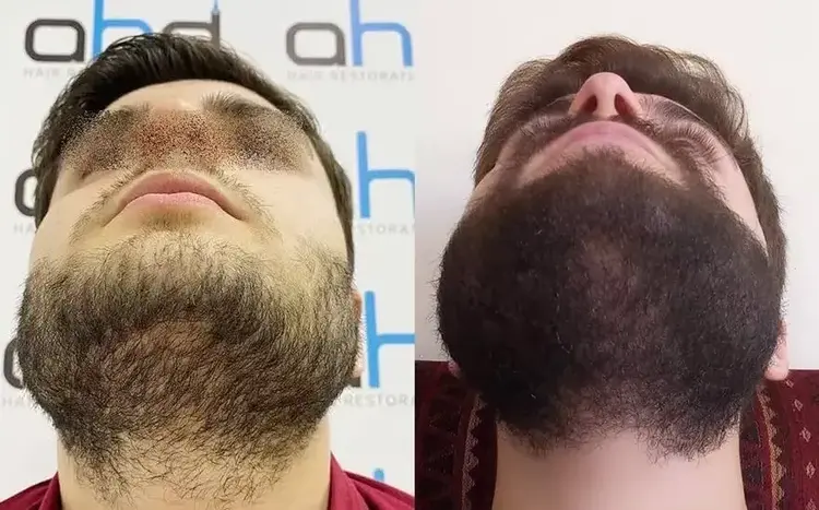 Des résultats très satisfaisants peuvent être obtenus grâce au processus de densification dans la greffe de barbe.