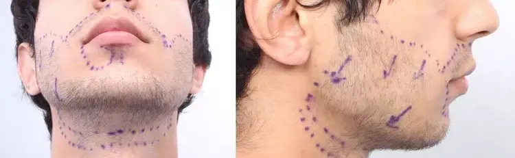 Pour obtenir un résultat naturel lors d'une greffe de barbe, il est impératif que les directions et les angles (des implants) soient corrects.