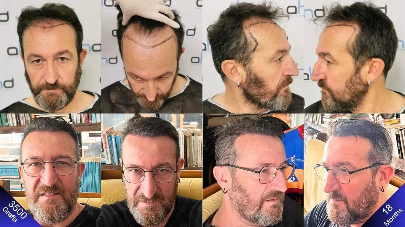 Quer saber como um transplante capilar pode ficar natural? É só olhar para o homem nesta foto.