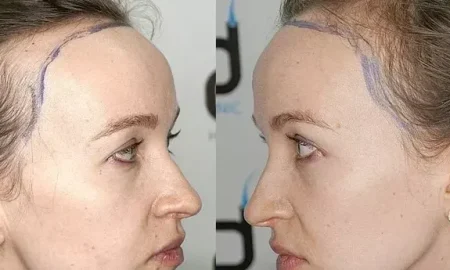 mujer con trasplante de cabello