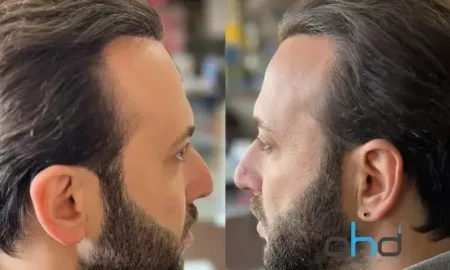 nach der Haartransplantation